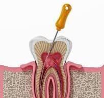 Root Canal Treatment